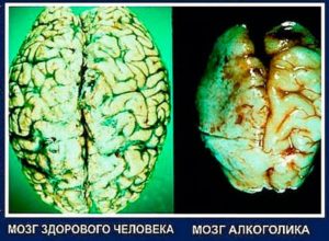 Разрушение мозга человека