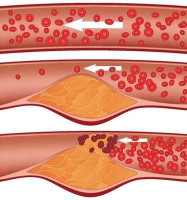 Стадии атеросклероза