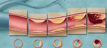 склероз сосудов