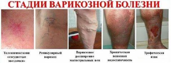 стадии варикоза