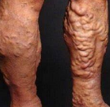 Тромбофлебит